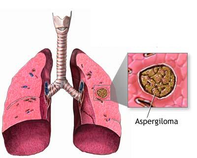 La aspergilosis es una infección pulmonar aguda causada por el hongo del género Aspergillus.