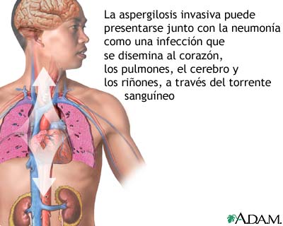 La aspergilosis es una infección pulmonar aguda causada por el hongo del género Aspergillus.